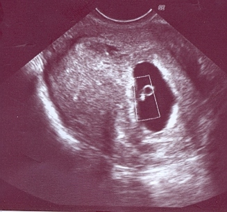 8 недель нет сердцебиения. УЗИ 6 недель сердцебиение. Сердечко эмбриона на 6 неделе. Сердечко малыша на УЗИ 6 недели. УЗИ 7 недель беременности.